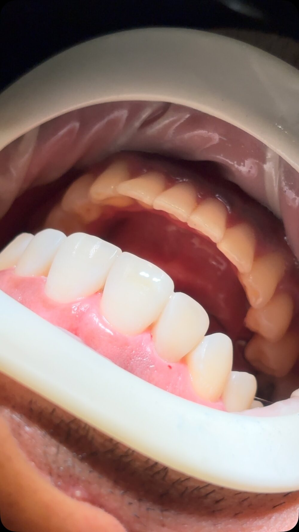 Prótese protocolo sobre implantes
